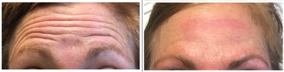 Botox before and after photo