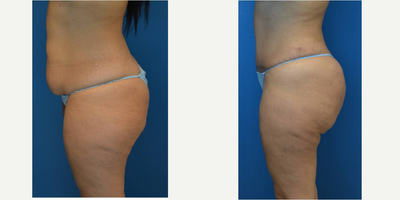 Brazilian Butt Lift before and after photo