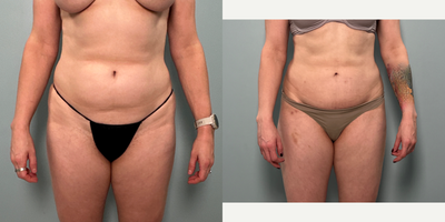 Liposuction before and after photo