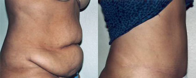 Tummy Tuck before and after photo