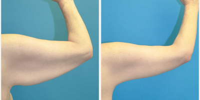 Arm Lift before and after photo