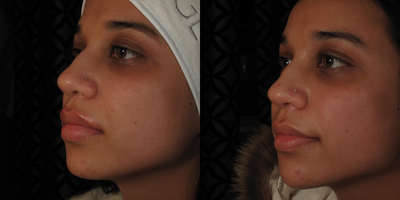 Dermal Fillers before and after photo