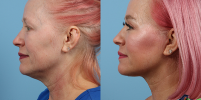 Facelift before and after photo