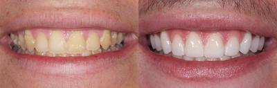 Porcelain Veneers before and after photo
