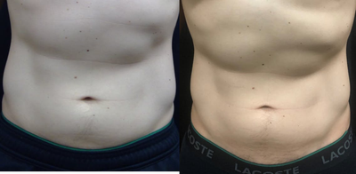 SculpSure before and after photo