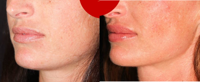 Juvederm before and after photo