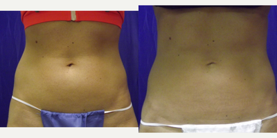 CoolSculpting before and after photo