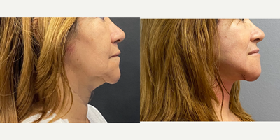 Facelift before and after photo