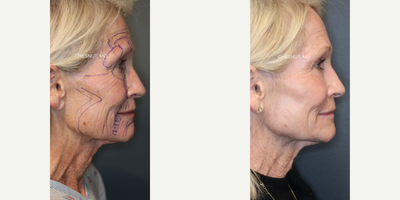 Laser Resurfacing before and after photo