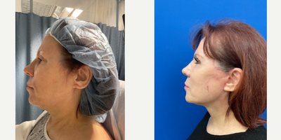 Mini Facelift before and after photo
