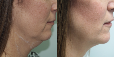 Nonsurgical Neck Lift before and after photo