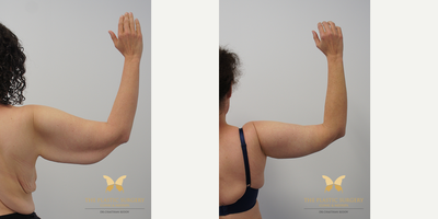 Arm Lift before and after photo