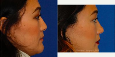 Asian Rhinoplasty before and after photo