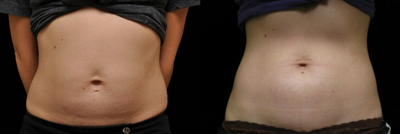 CoolSculpting before and after photo