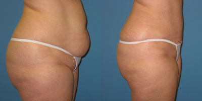 Tummy Tuck before and after photo