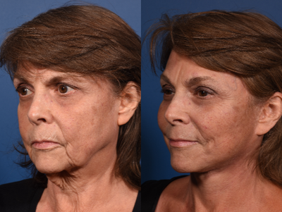 Deep Plane Facelift before and after photo