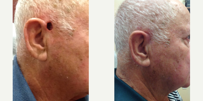 Mohs Surgery before and after photo