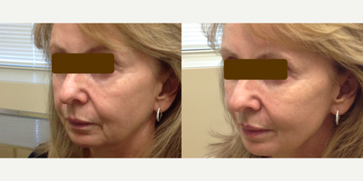Restylane before and after photo