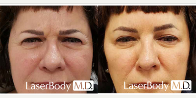 Botox before and after photo