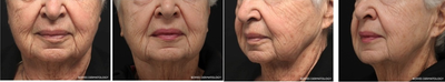 Profound RF before and after photo