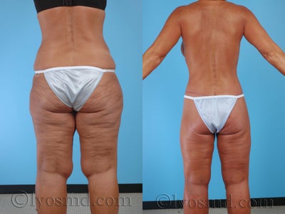 Body Lift before and after photo