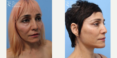 Facelift before and after photo