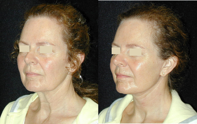Neck Lift before and after photo