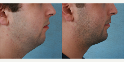 Chin Implant before and after photo