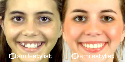 Clear Braces before and after photo