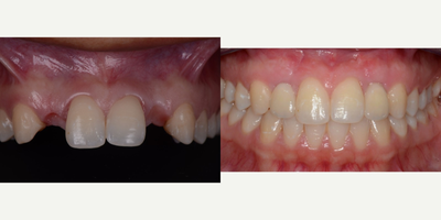 Dental Implants before and after photo