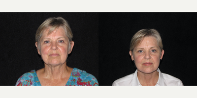 Facelift before and after photo