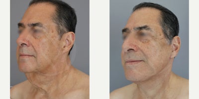 Facelift before and after photo