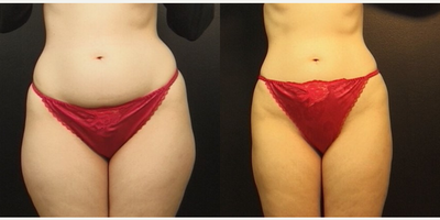 Liposuction before and after photo