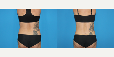 Liposuction before and after photo