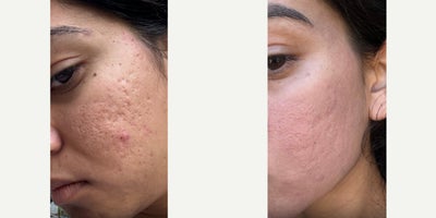 CO2 Laser before and after photo