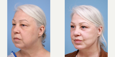 Lip Lift before and after photo