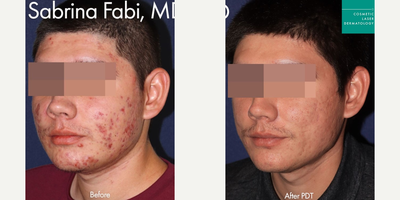Photodynamic Therapy before and after photo