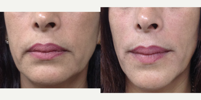 Radiesse before and after photo