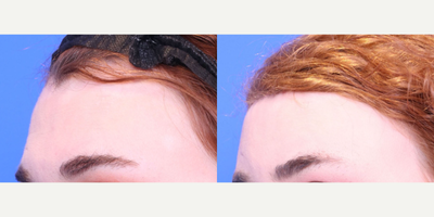 Transgender Facial Feminization Surgery before and after photo