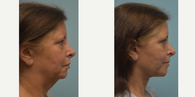 Double Eyelid Surgery before and after photo
