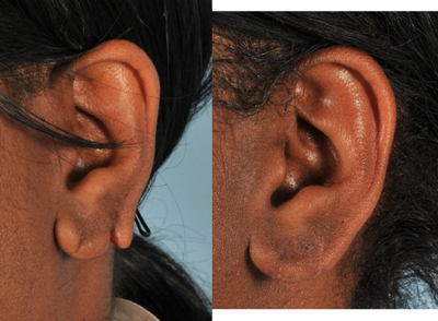 Earlobe Repair before and after photo
