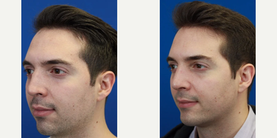 Revision Rhinoplasty before and after photo
