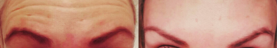 Botox before and after photo