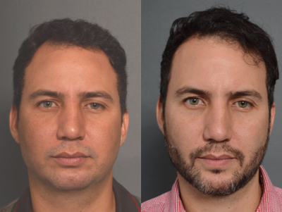 Buccal Fat Removal before and after photo