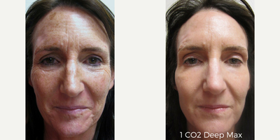 CO2 Laser before and after photo