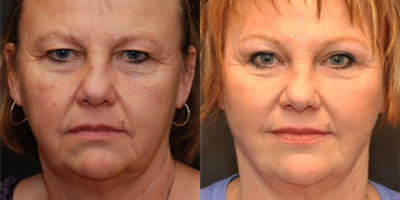 Eyelid Surgery before and after photo