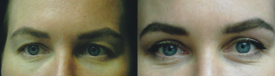 Eyelid Surgery before and after photo