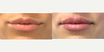 Lip Fillers before and after photo