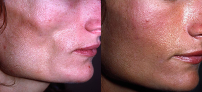 Silikon 1000 before and after photo
