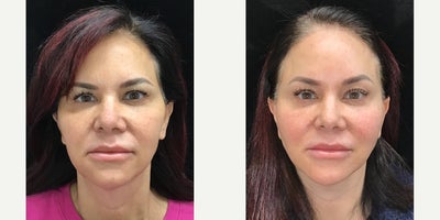 Facelift before and after photo